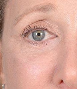 Eyelid Surgery Before & After Gallery - Patient 151398571 - Image 2