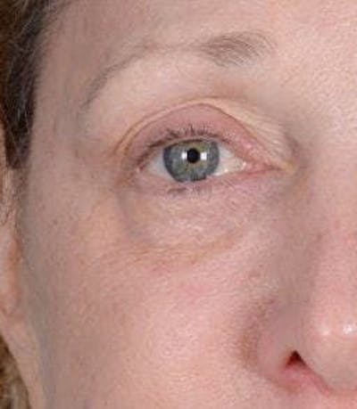 Eyelid Surgery Before & After Gallery - Patient 151398571 - Image 1