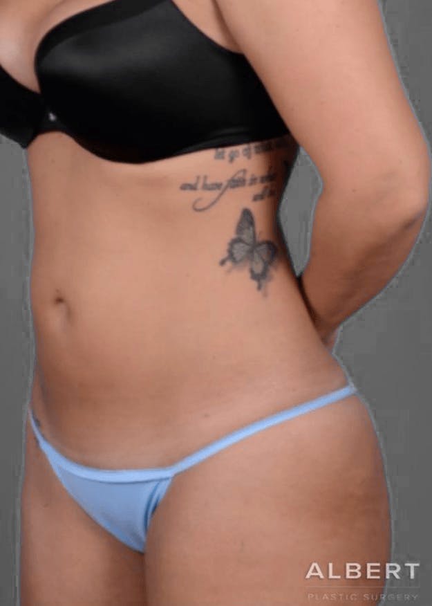 Liposuction Before & After Gallery - Patient 151452154 - Image 3