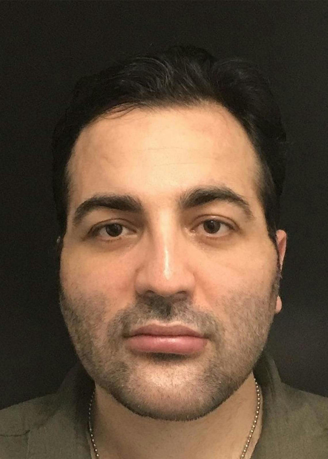 Buccal Fat Removal Before & After Gallery - Patient 151362558 - Image 2