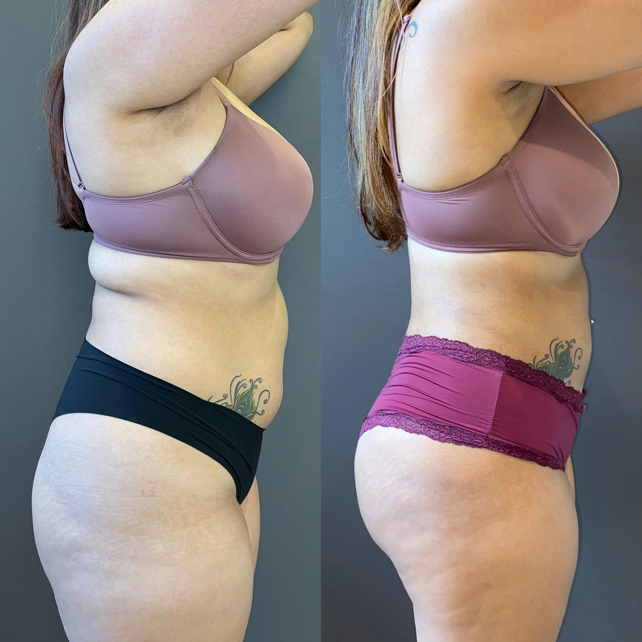 BBL Before & After Gallery - Patient 151351660 - Image 2