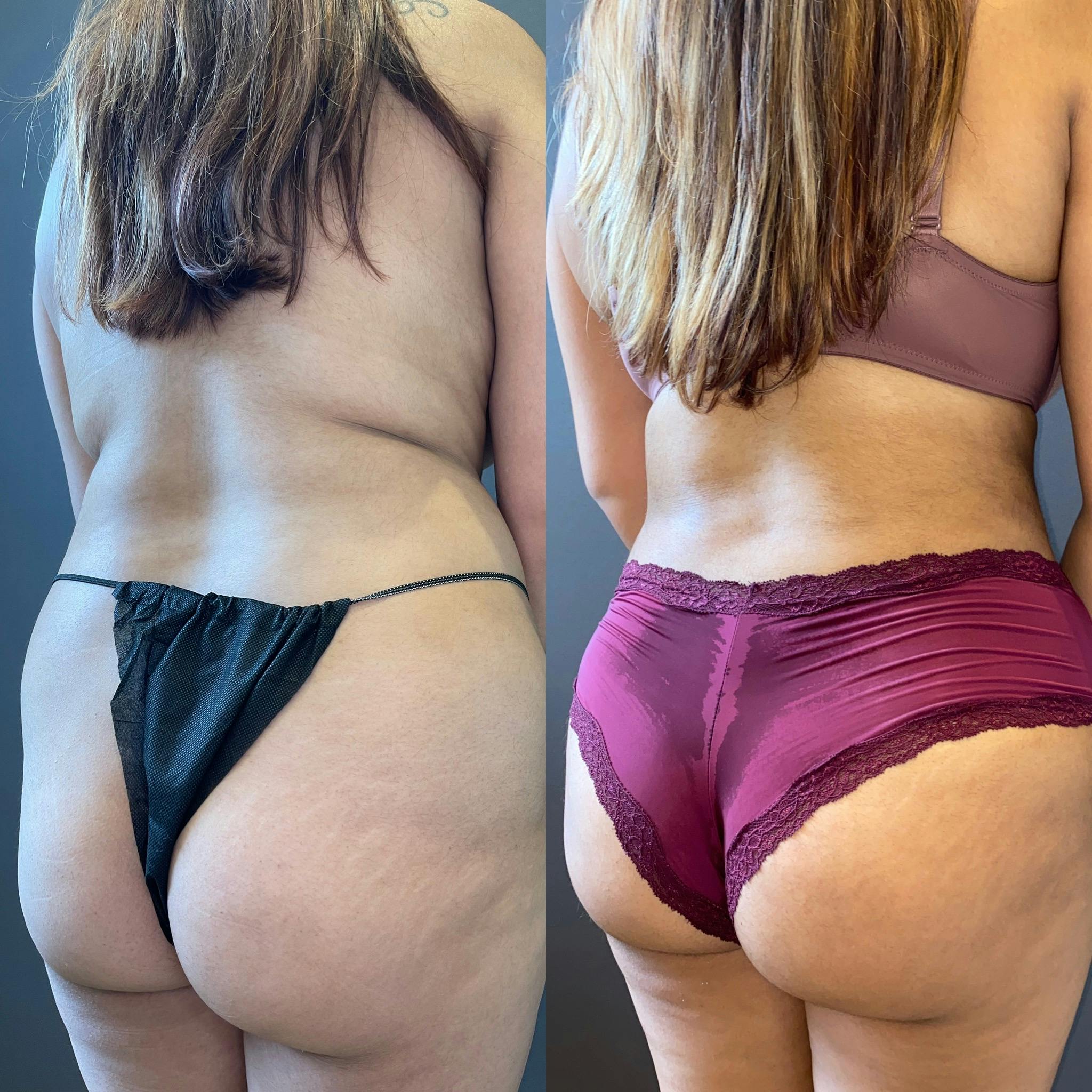 BBL Before & After Gallery - Patient 151351660 - Image 3