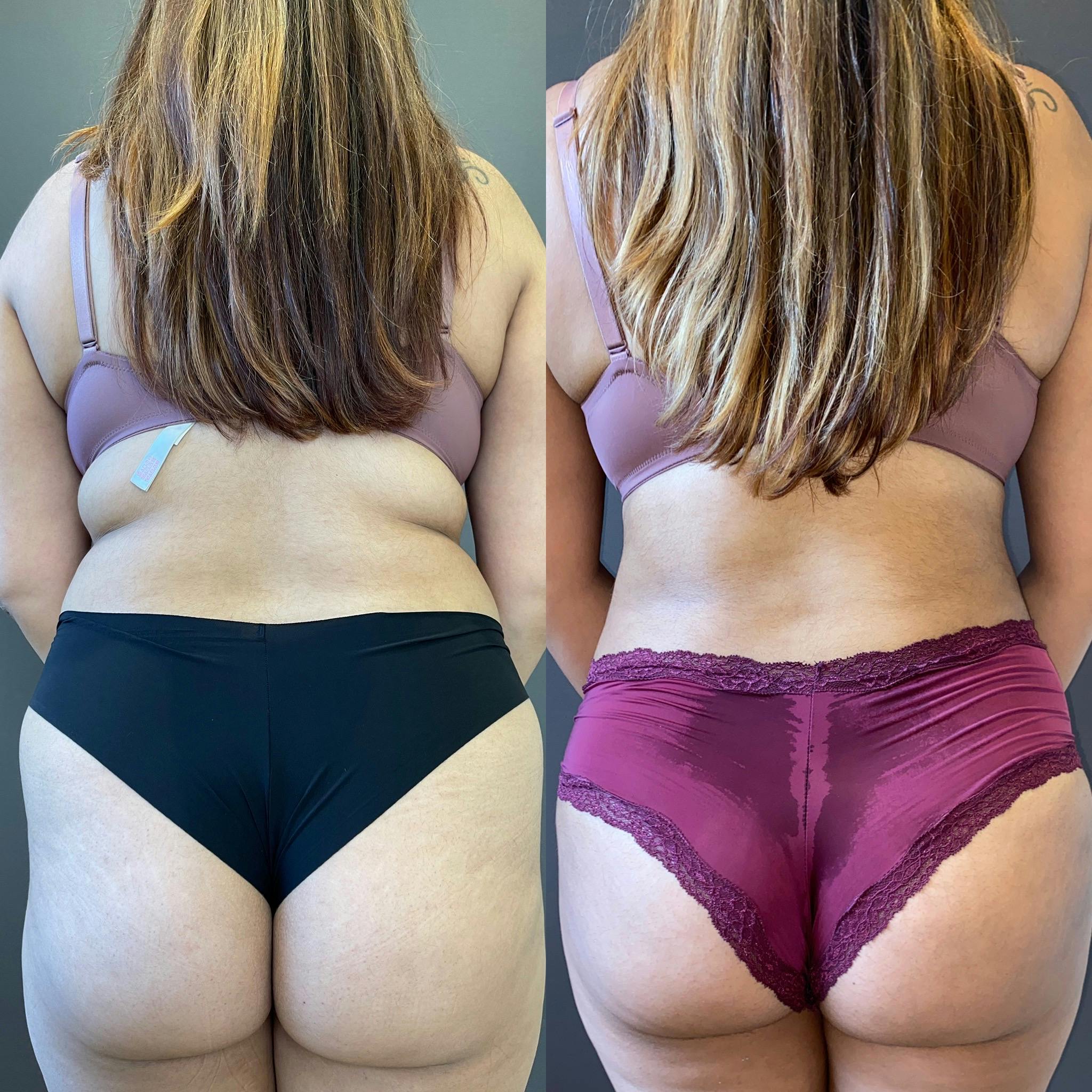 BBL Before & After Gallery - Patient 151351660 - Image 1