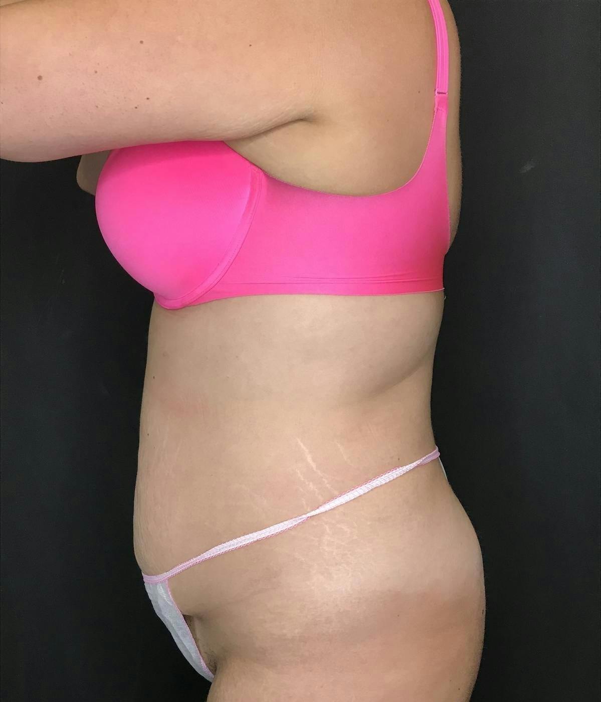 Tummy Tuck Before & After Gallery - Patient 151521126 - Image 3