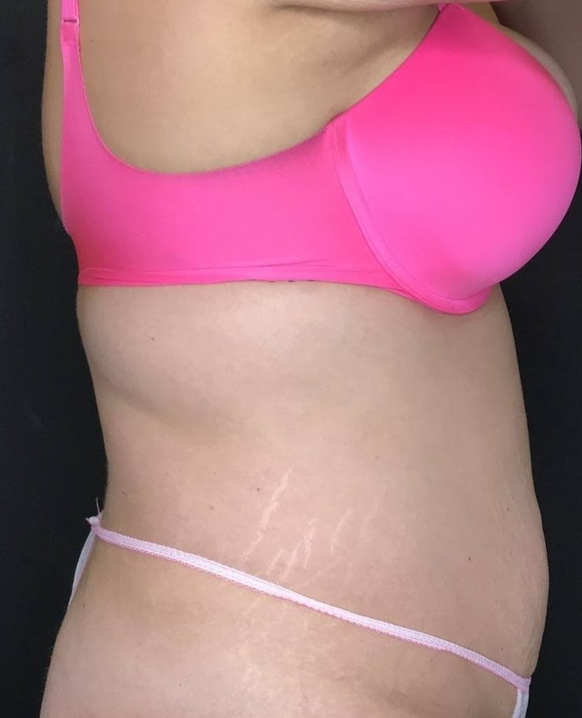 Tummy Tuck Before & After Gallery - Patient 151521126 - Image 5