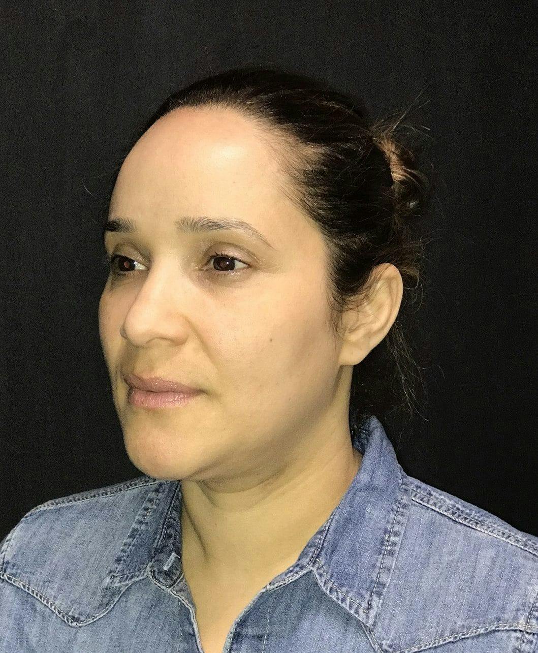 Rhinoplasty Before & After Gallery - Patient 151510788 - Image 5