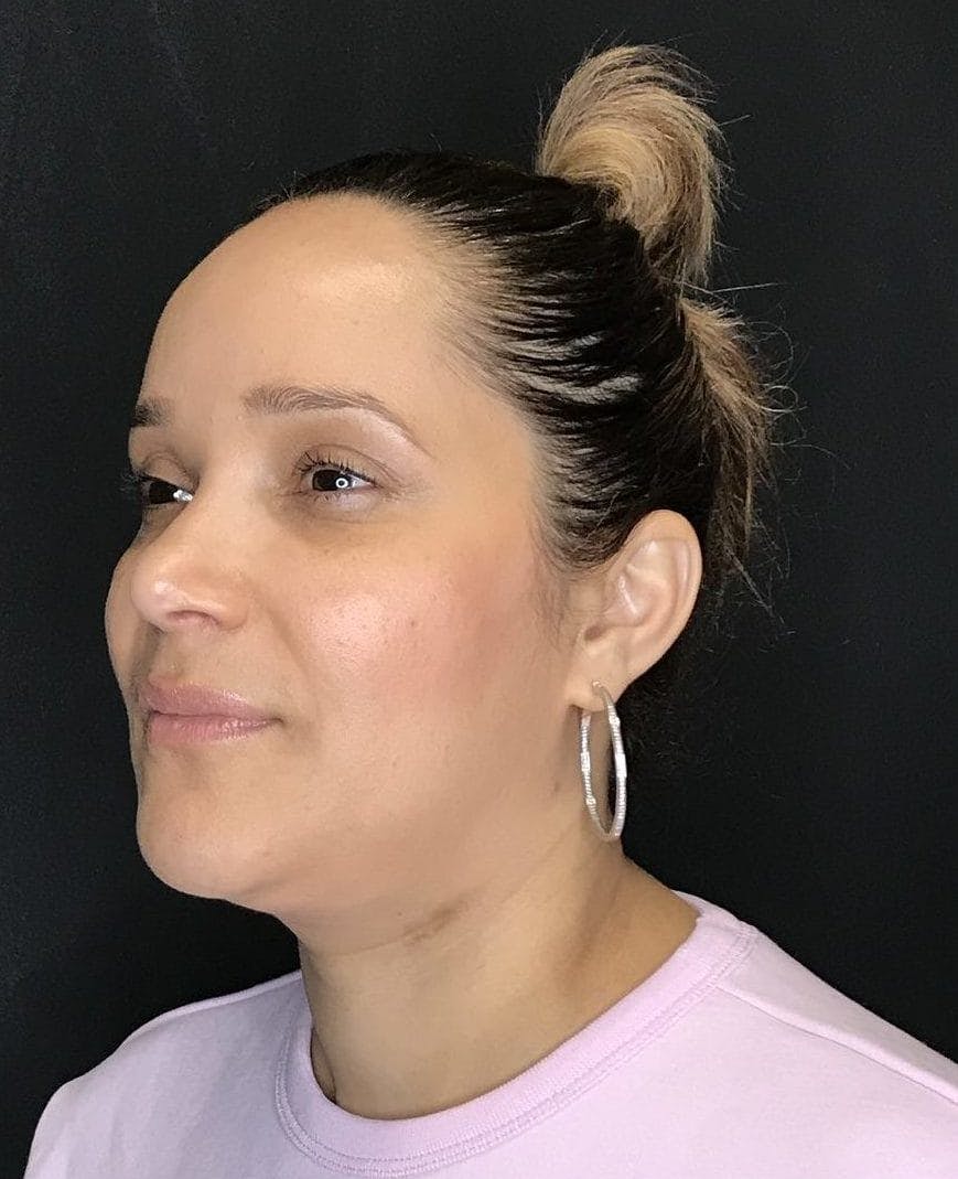Rhinoplasty Before & After Gallery - Patient 151510788 - Image 6