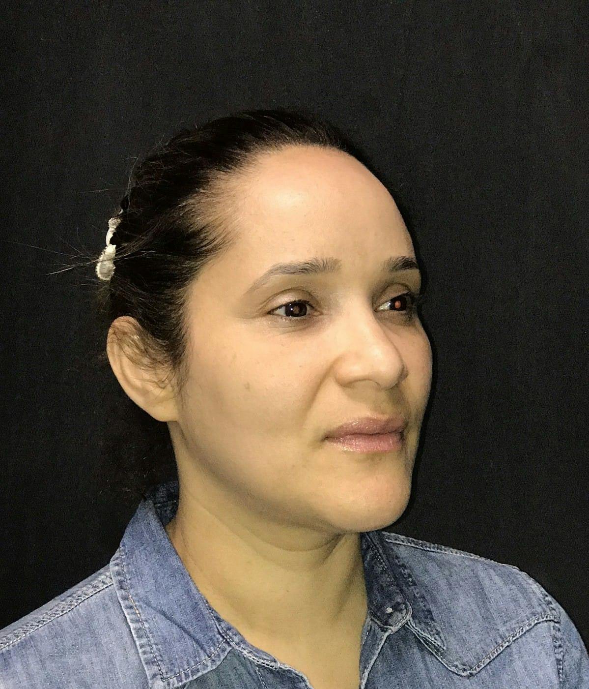 Rhinoplasty Before & After Gallery - Patient 151510788 - Image 3