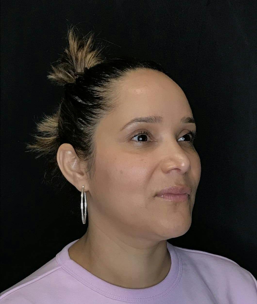 Rhinoplasty Before & After Gallery - Patient 151510788 - Image 4