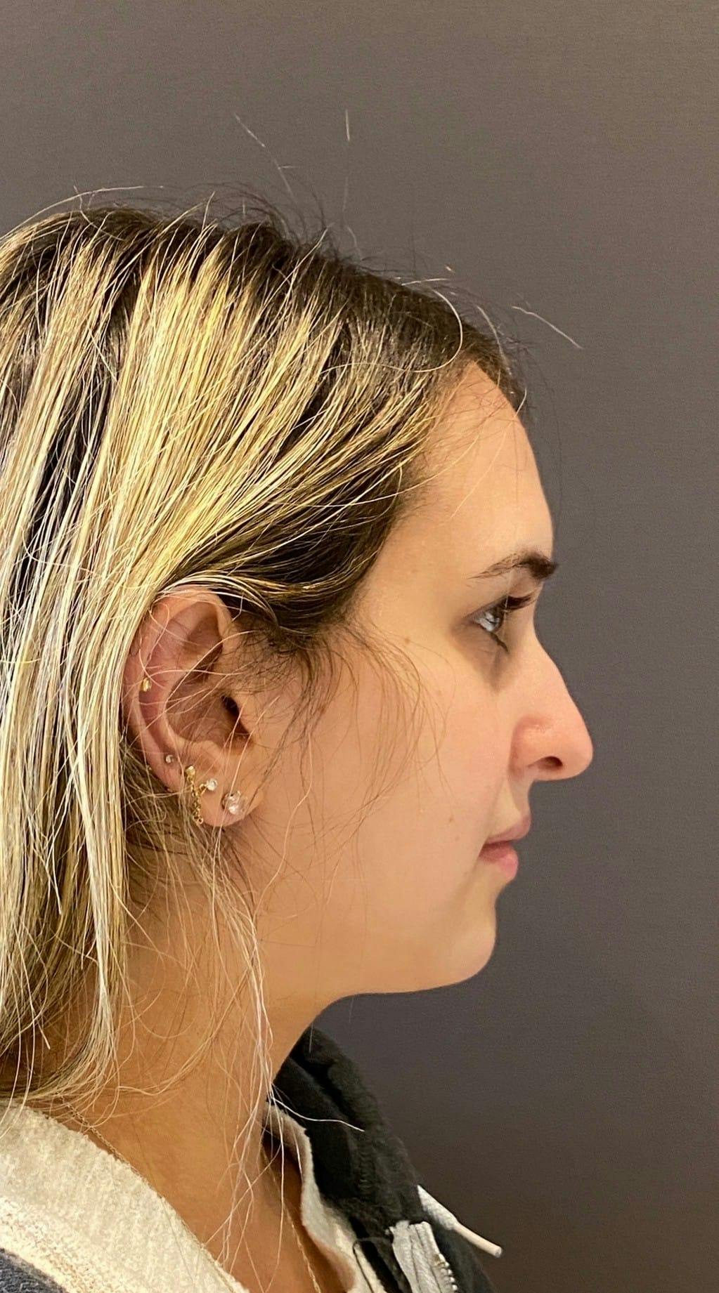 Rhinoplasty Before & After Gallery - Patient 151510792 - Image 1