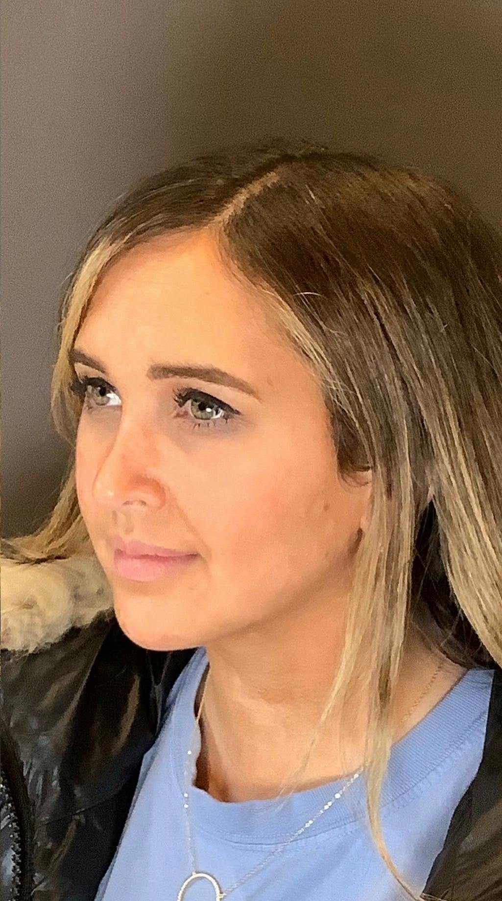 Rhinoplasty Before & After Gallery - Patient 151510792 - Image 6