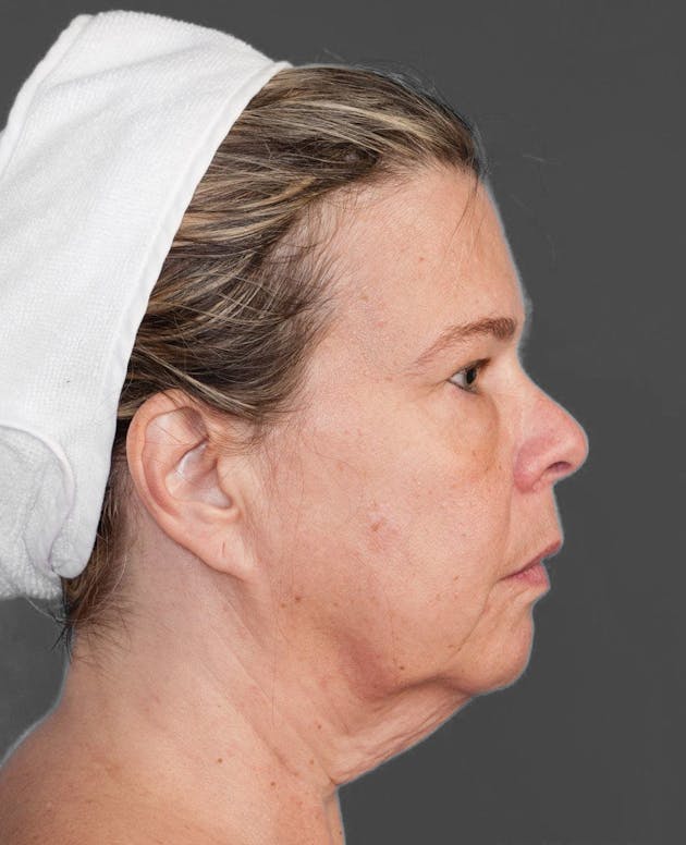 Facelift & Necklift before in NYC, patient 151452109