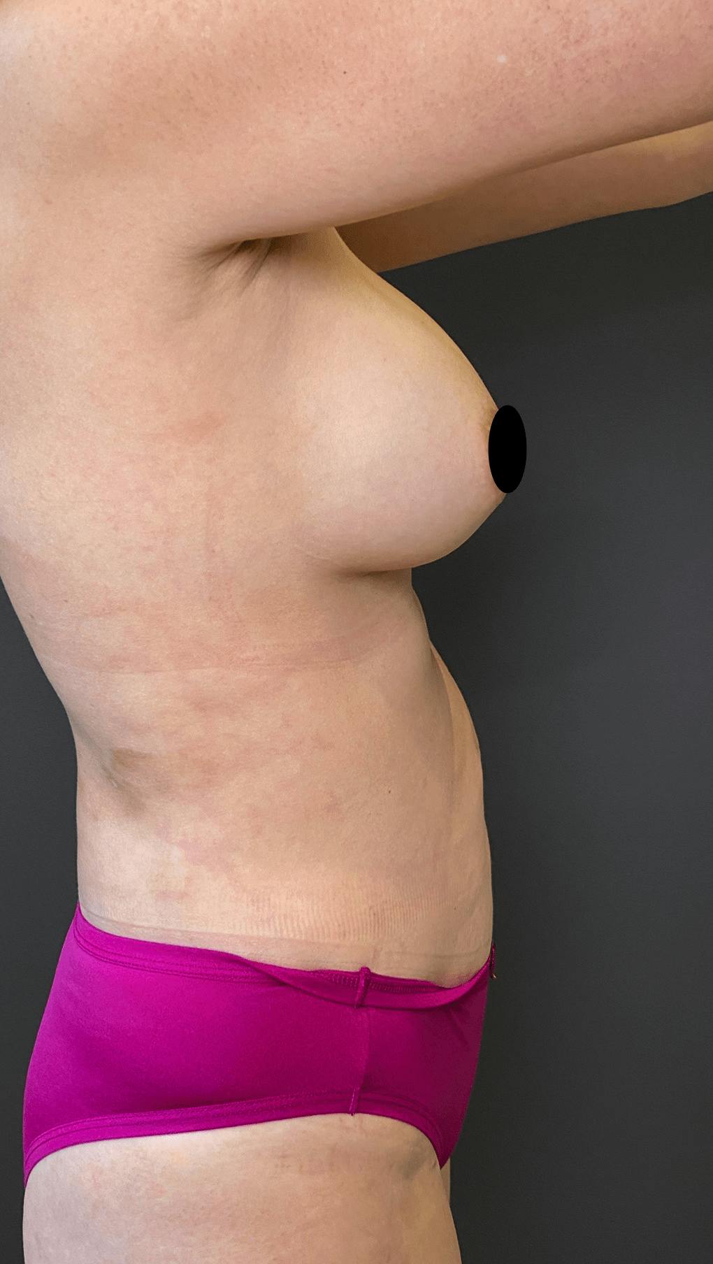 Liposuction Before & After Gallery - Patient 151452153 - Image 10