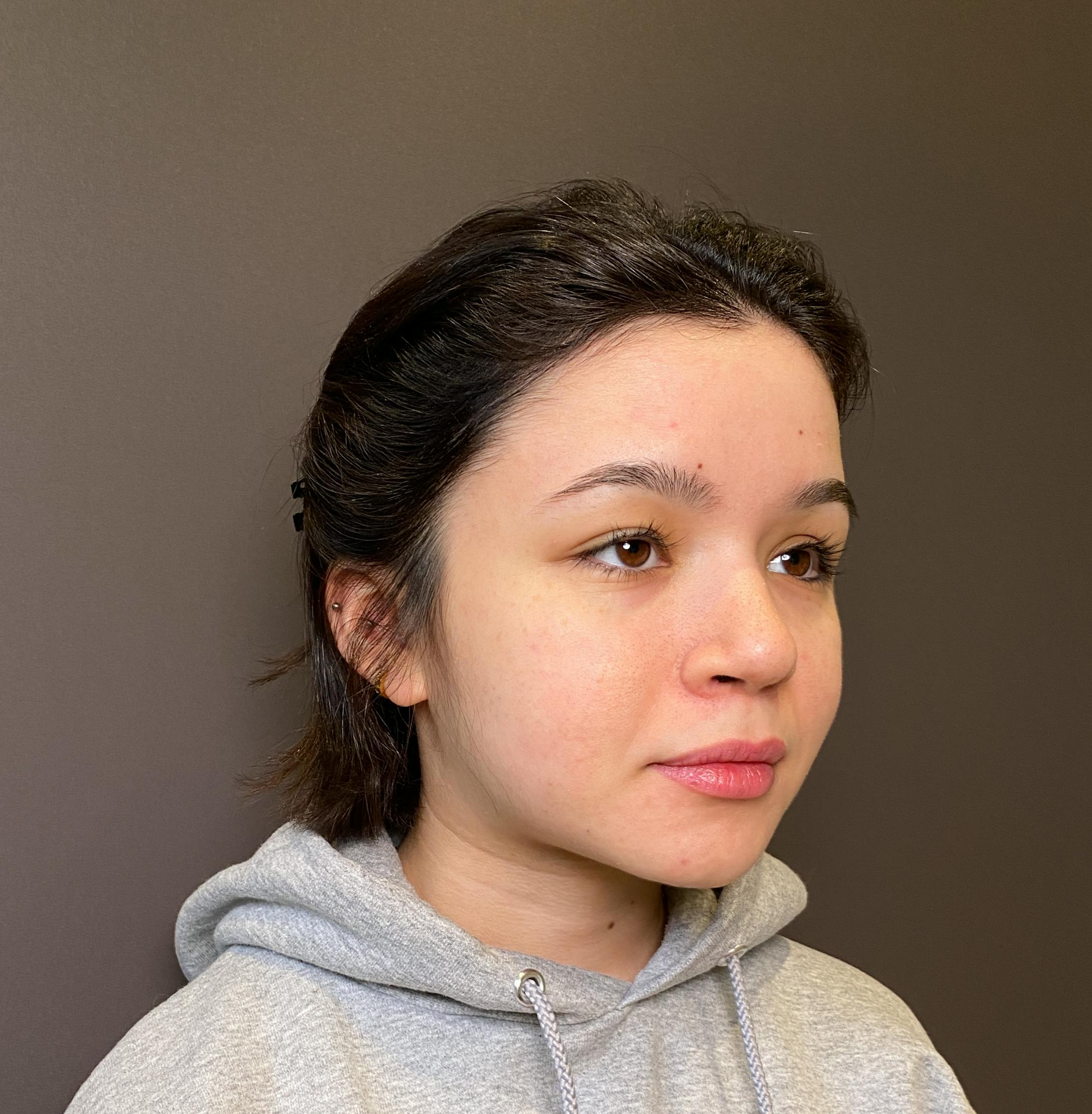 Rhinoplasty Before & After Gallery - Patient 151510779 - Image 4