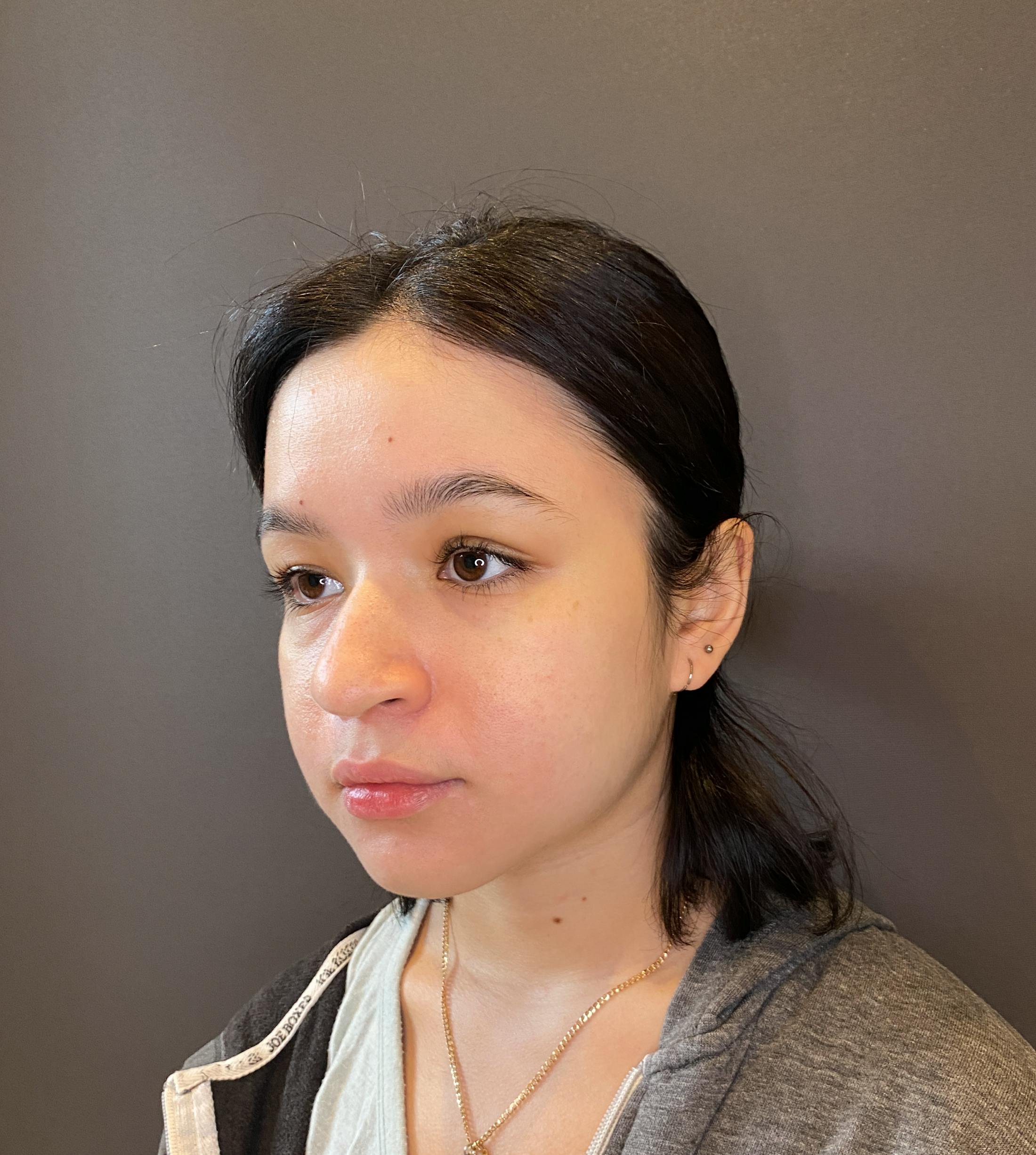 Rhinoplasty Before & After Gallery - Patient 151510779 - Image 7