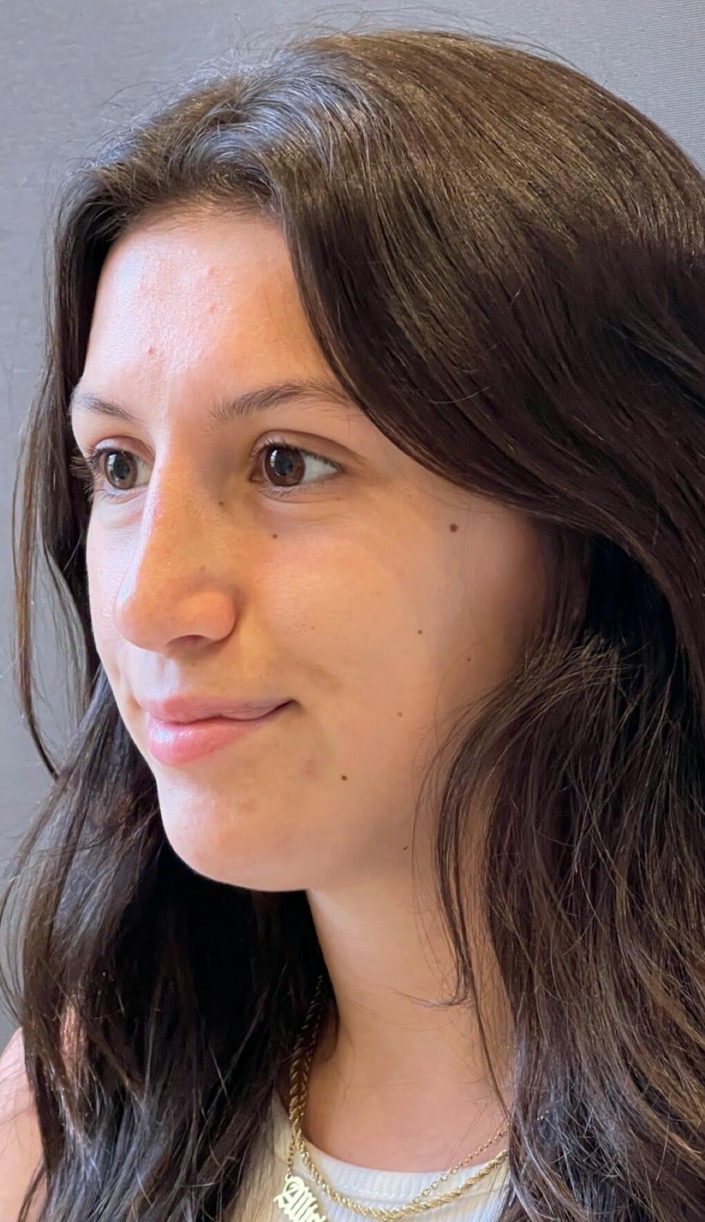 Rhinoplasty Before & After Gallery - Patient 151510791 - Image 8