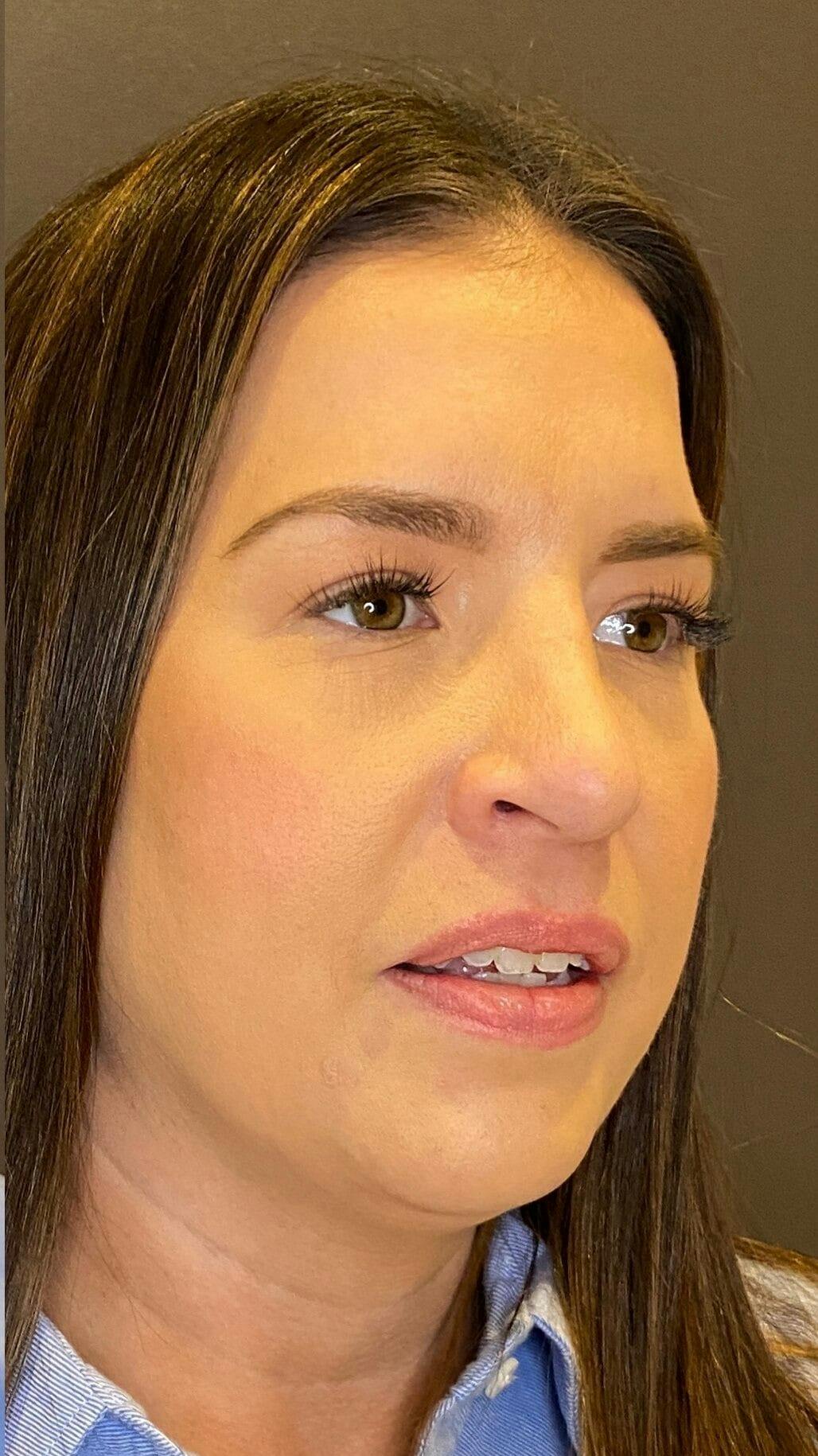 Rhinoplasty Before & After Gallery - Patient 151510790 - Image 4