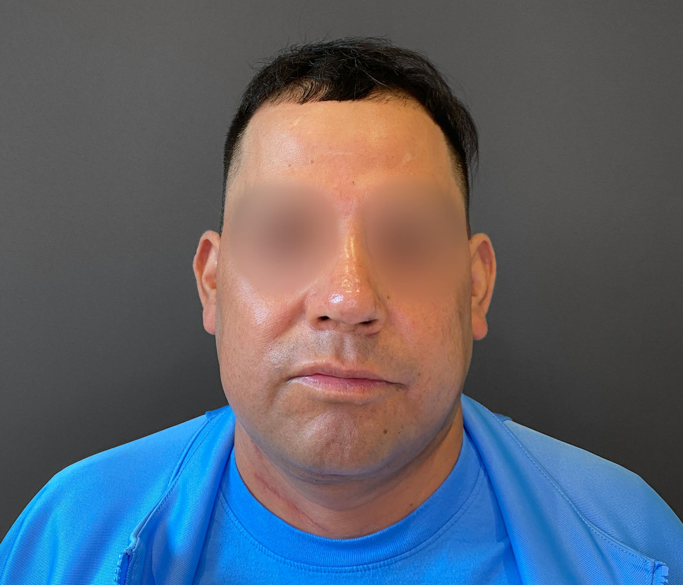 Revision Rhinoplasty Before & After Gallery - Patient 173906475 - Image 4