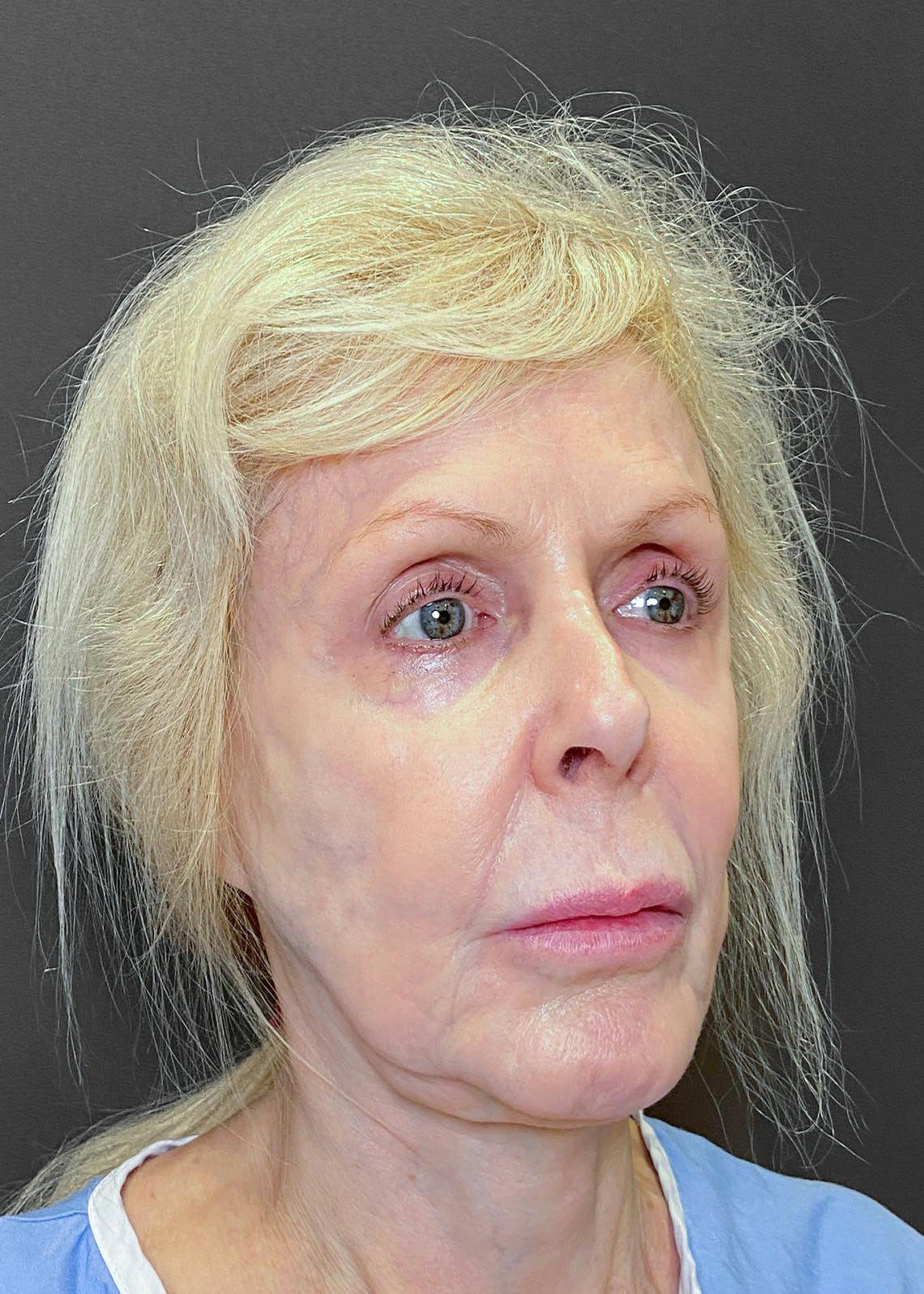 Facelifts / Necklift Before & After Gallery - Patient 151452107 - Image 2