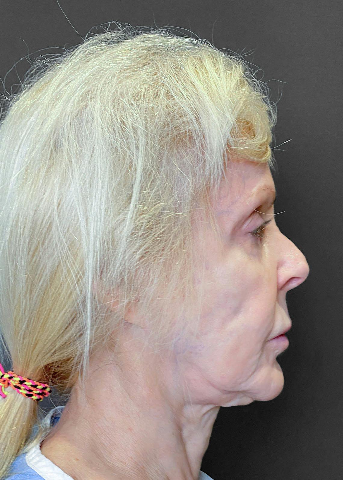 Facelifts / Necklift Before & After Gallery - Patient 151452107 - Image 3
