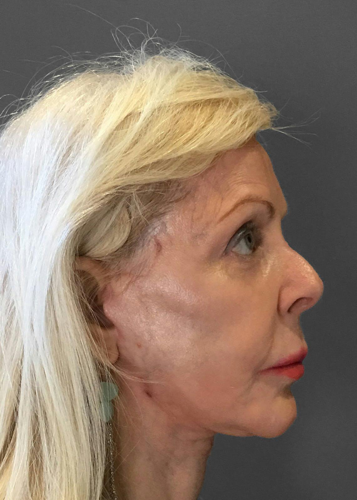 Facelifts / Necklift Before & After Gallery - Patient 151452107 - Image 4