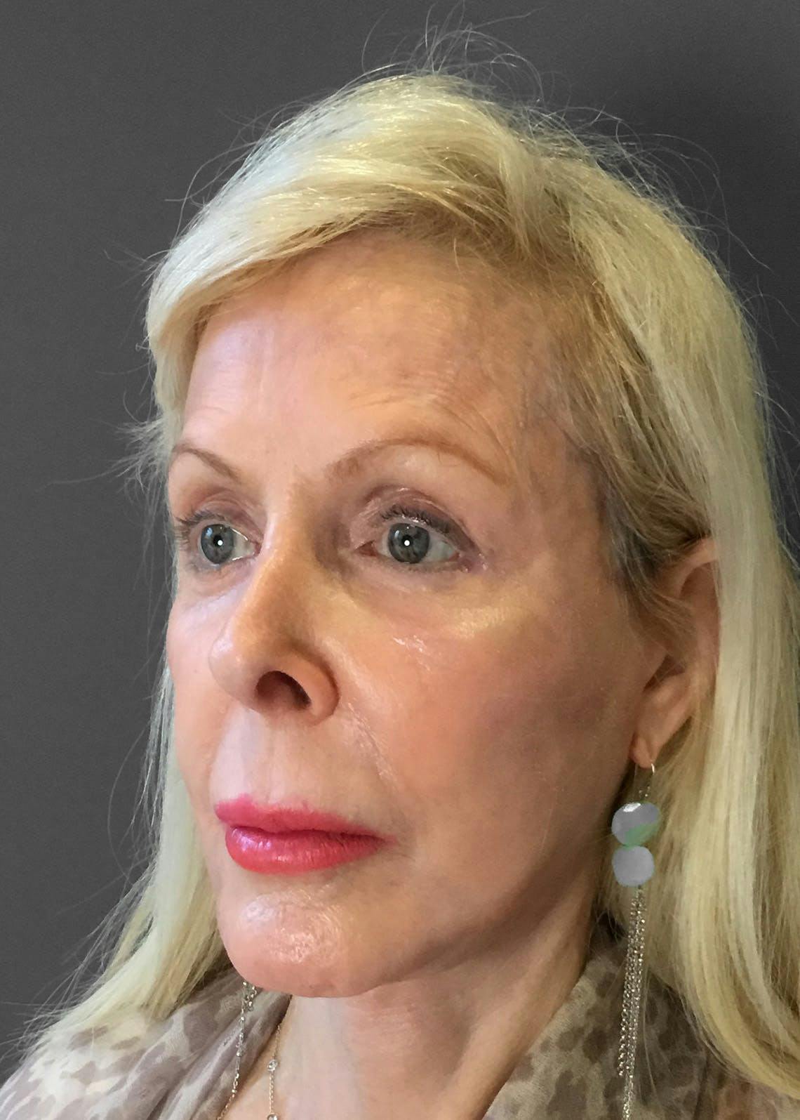 Facelifts / Necklift Before & After Gallery - Patient 151452107 - Image 8