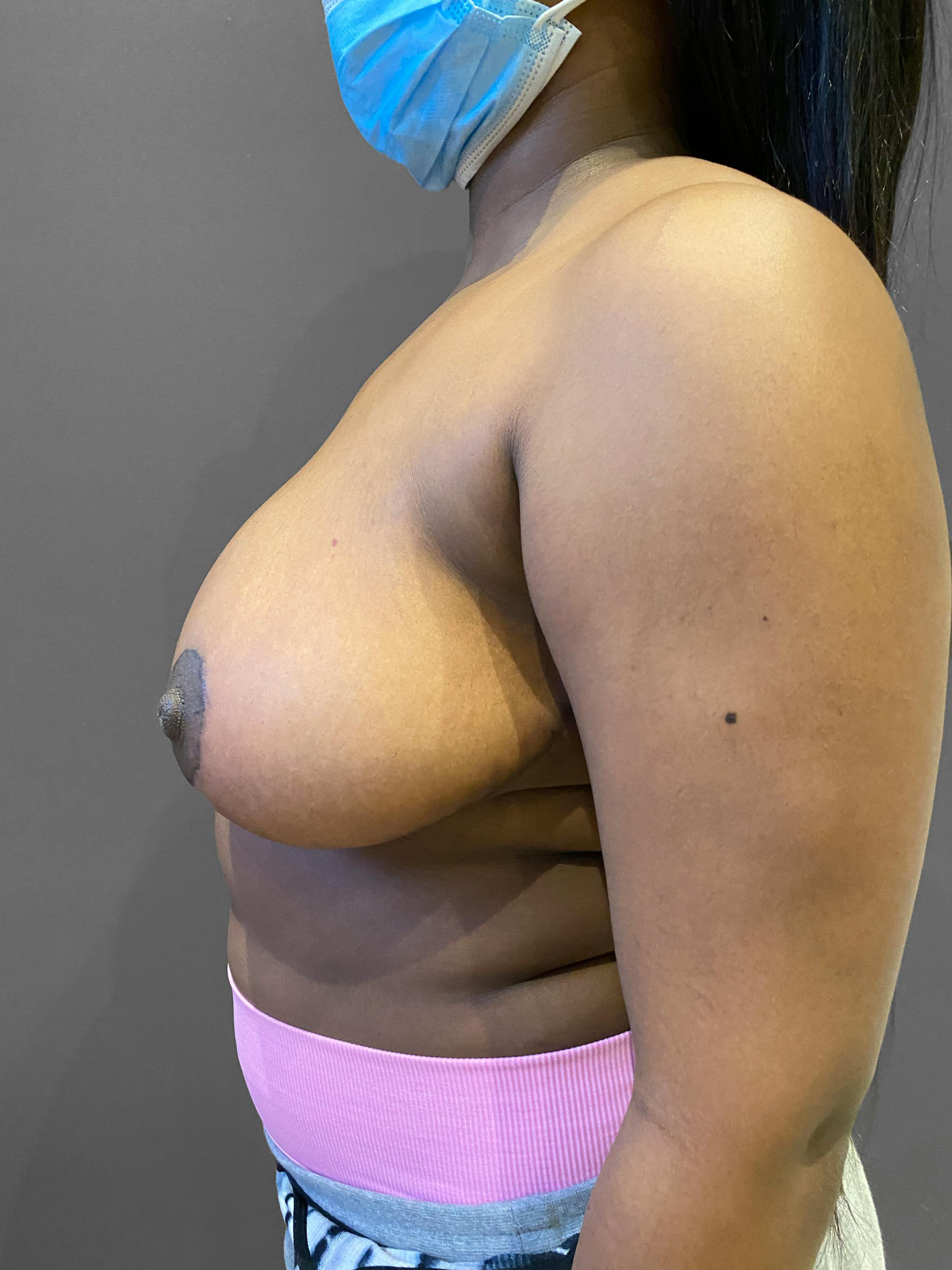 Breast Reduction Before & After Gallery - Patient 174274251 - Image 6