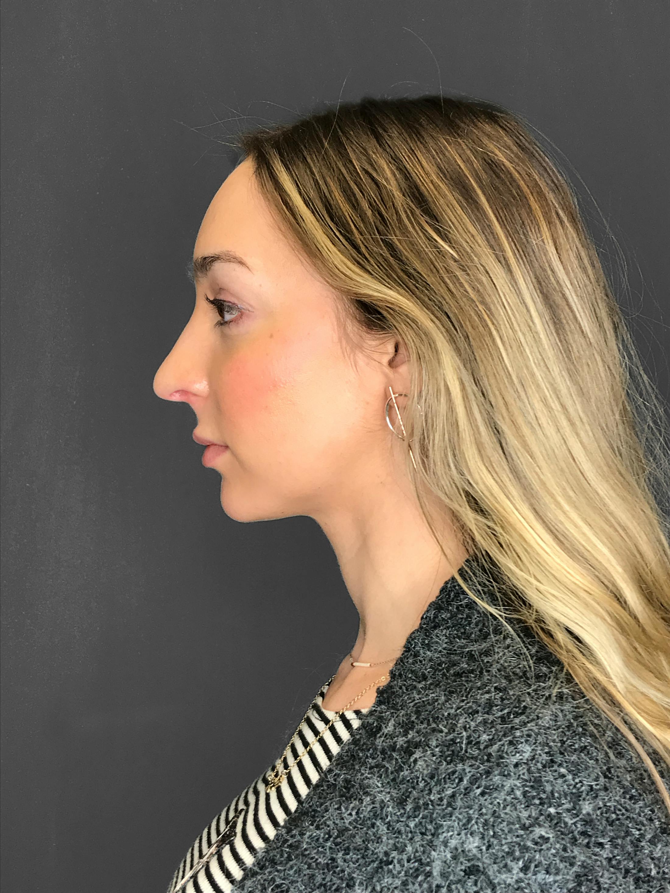 Facial Fat Transfer Before & After Gallery - Patient 151452116 - Image 5