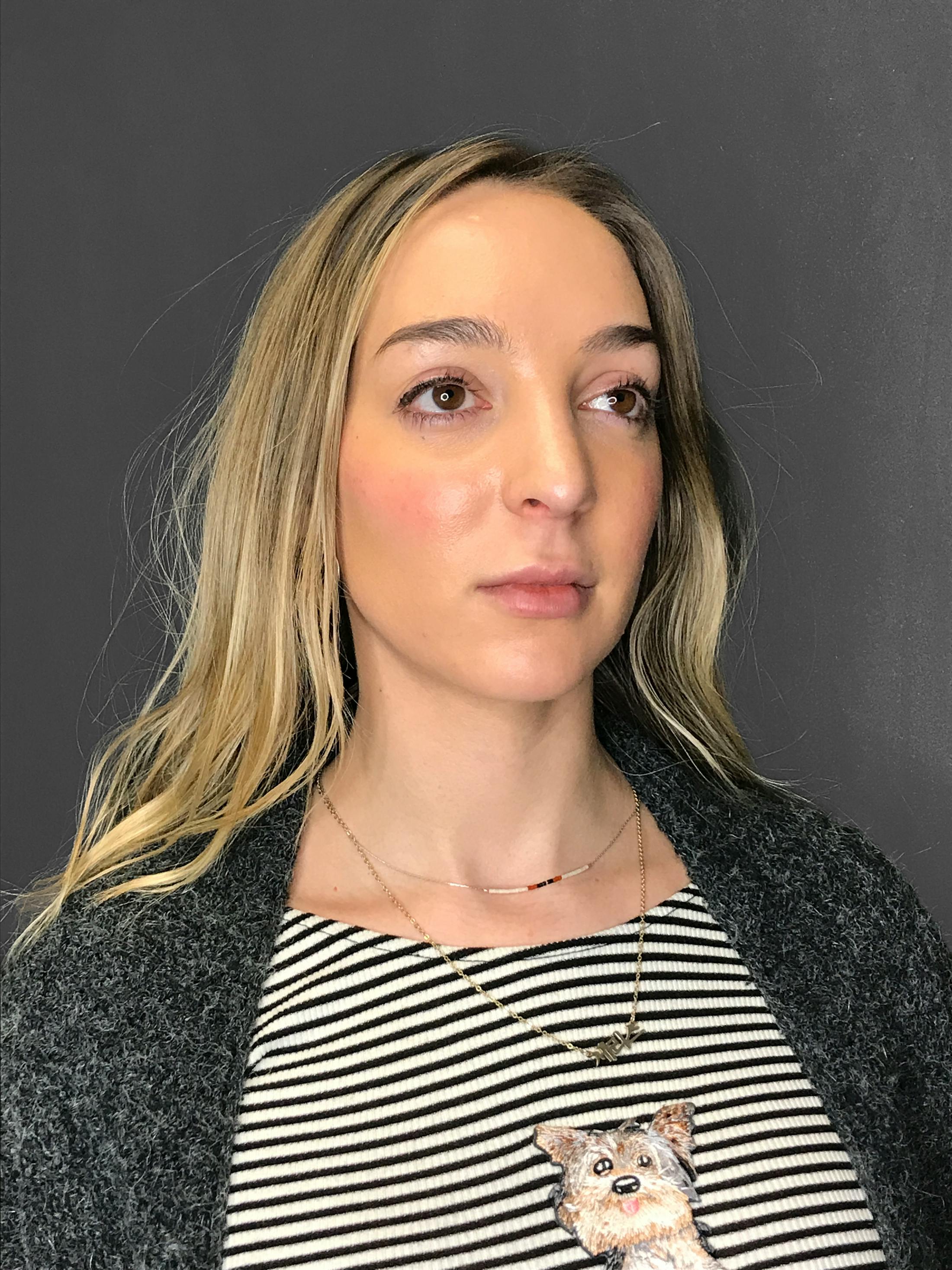 Facial Fat Transfer Before & After Gallery - Patient 151452116 - Image 7