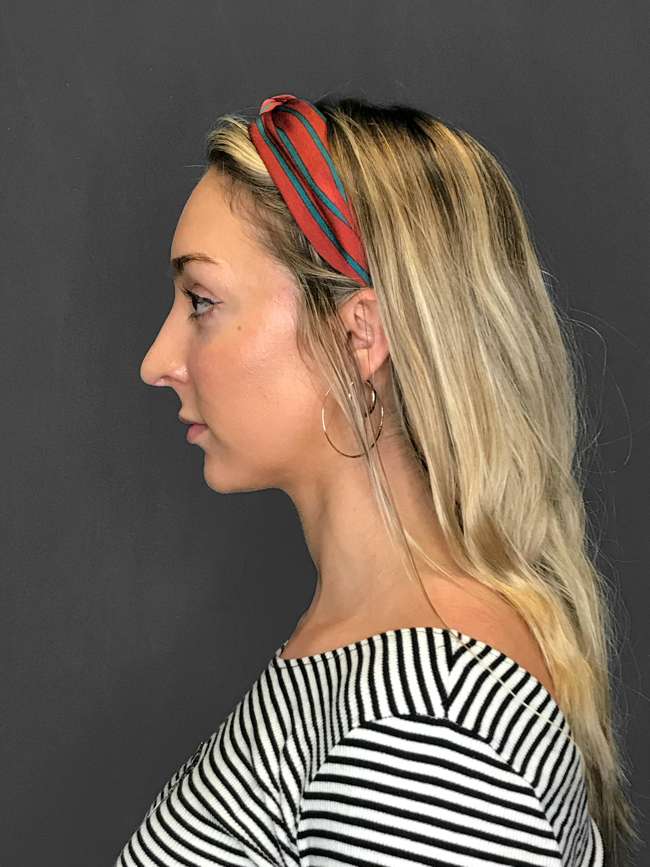 Facial Fat Transfer Before & After Gallery - Patient 151452116 - Image 6