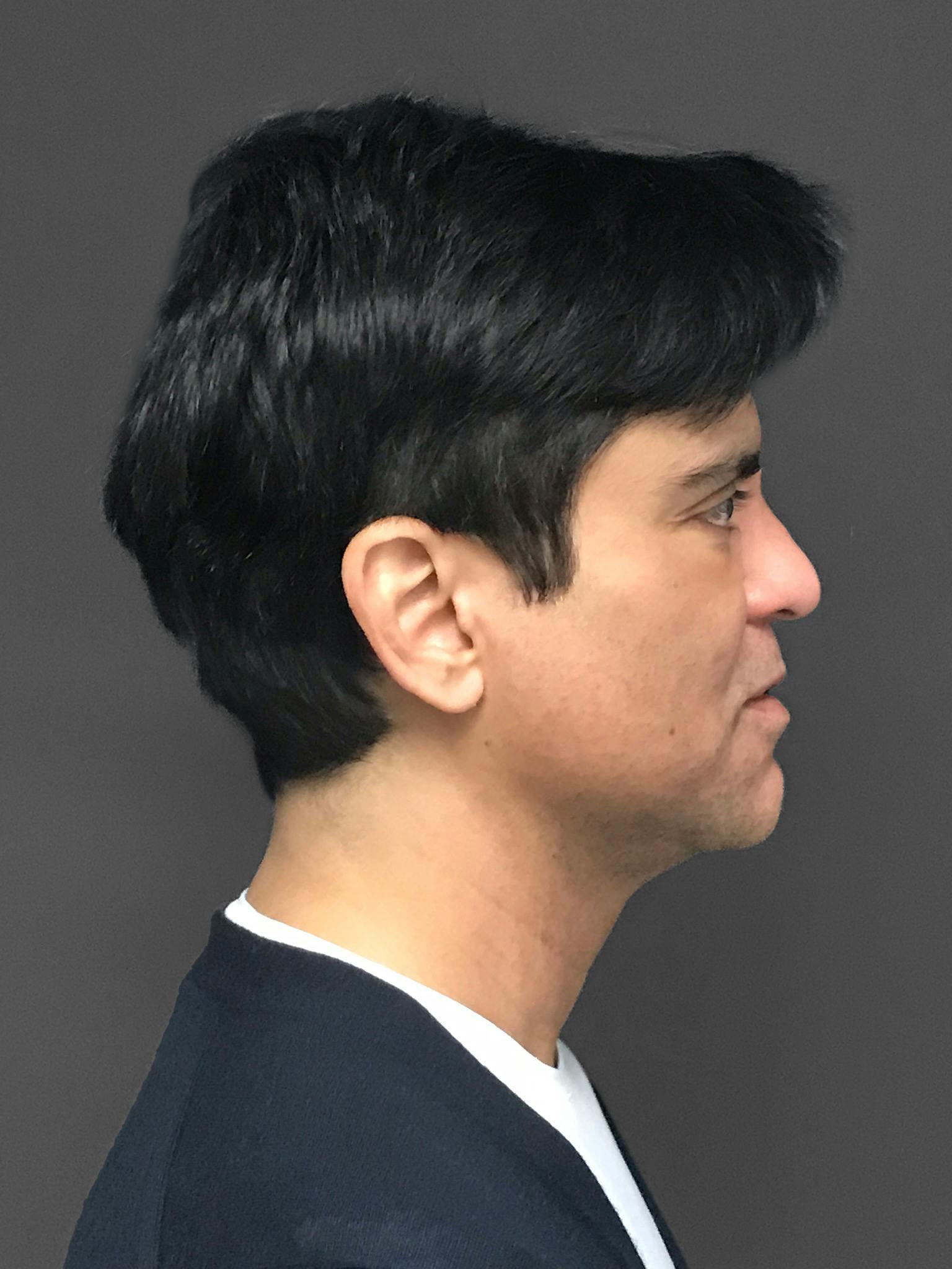 Facial Fat Transfer Before & After Gallery - Patient 151452117 - Image 10