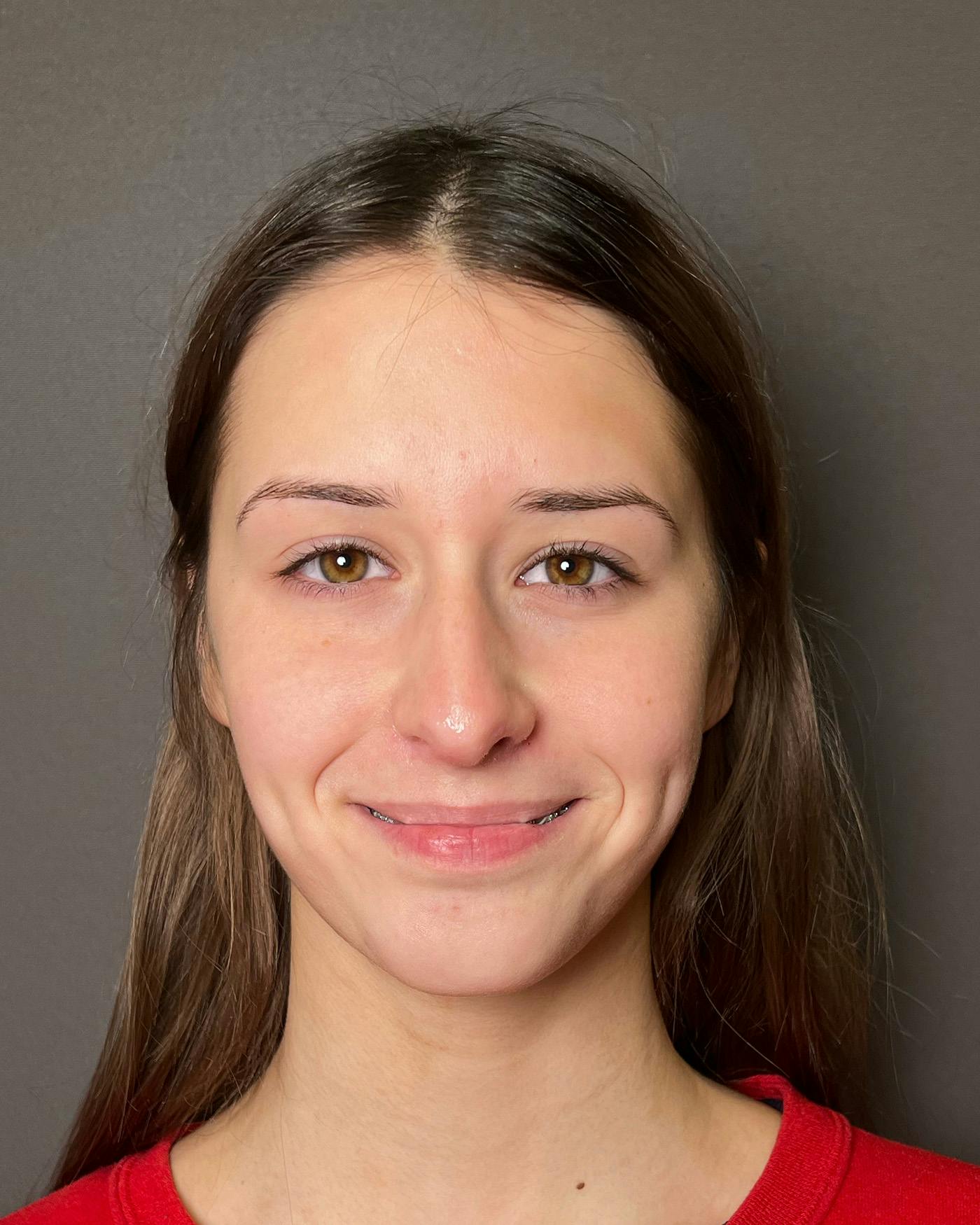 Rhinoplasty Before & After Gallery - Patient 191294098 - Image 3