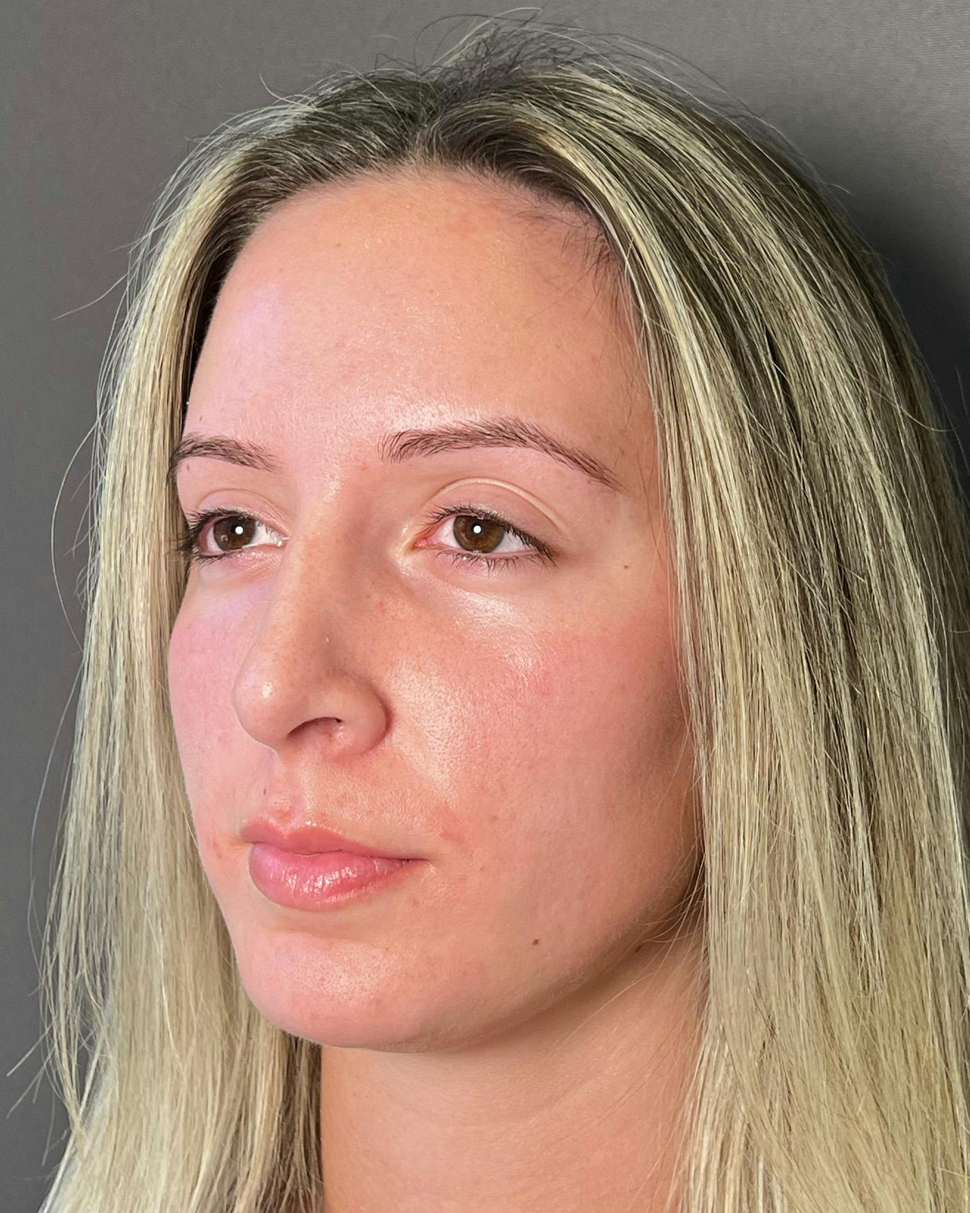 Revision Rhinoplasty Before & After Gallery - Patient 192560644 - Image 9
