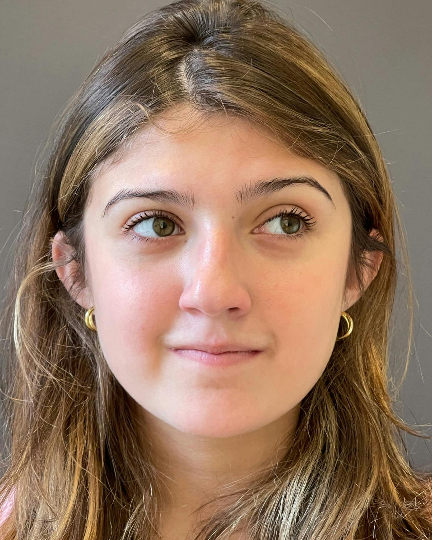 Rhinoplasty Before & After Gallery - Patient 191298487 - Image 5