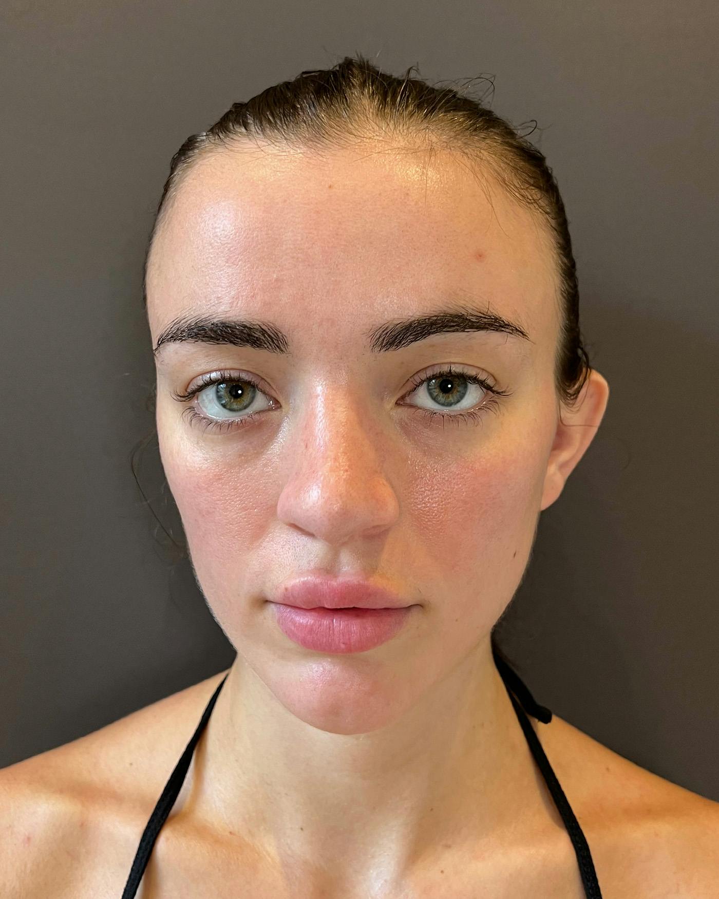 Rhinoplasty after in NYC with Albert Plastic Surgery front view p#3