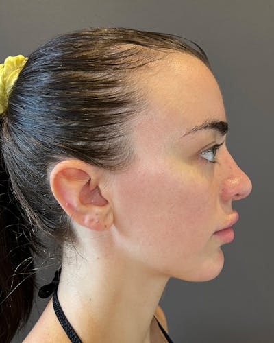 Rhinoplasty after in NYC with Albert Plastic Surgery right side view p#3