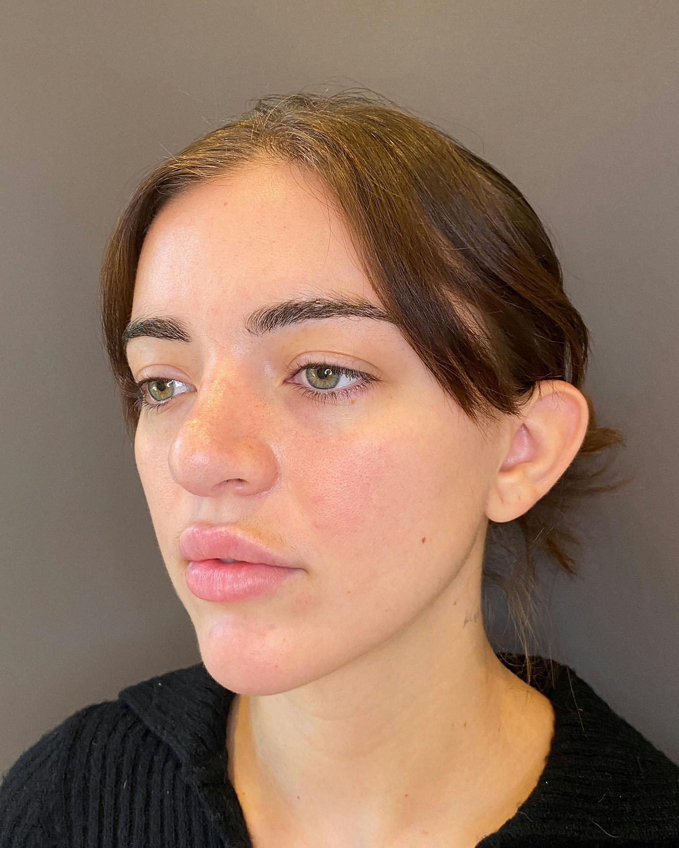 Rhinoplasty before in NYC with Albert Plastic Surgery right profile view p#3