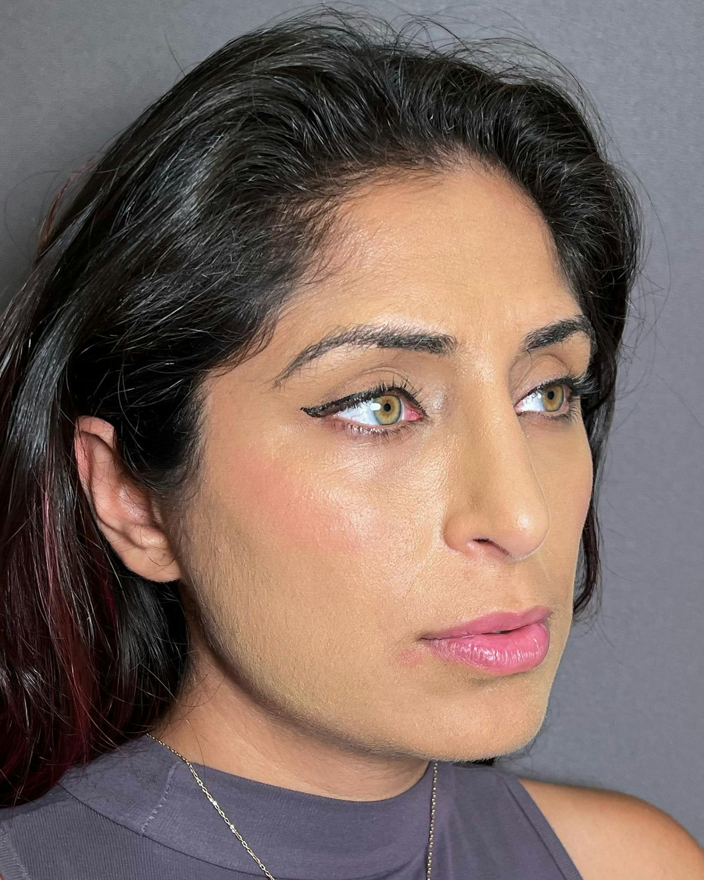 Rhinoplasty after in NYC with Albert Plastic Surgery right profile view p#2