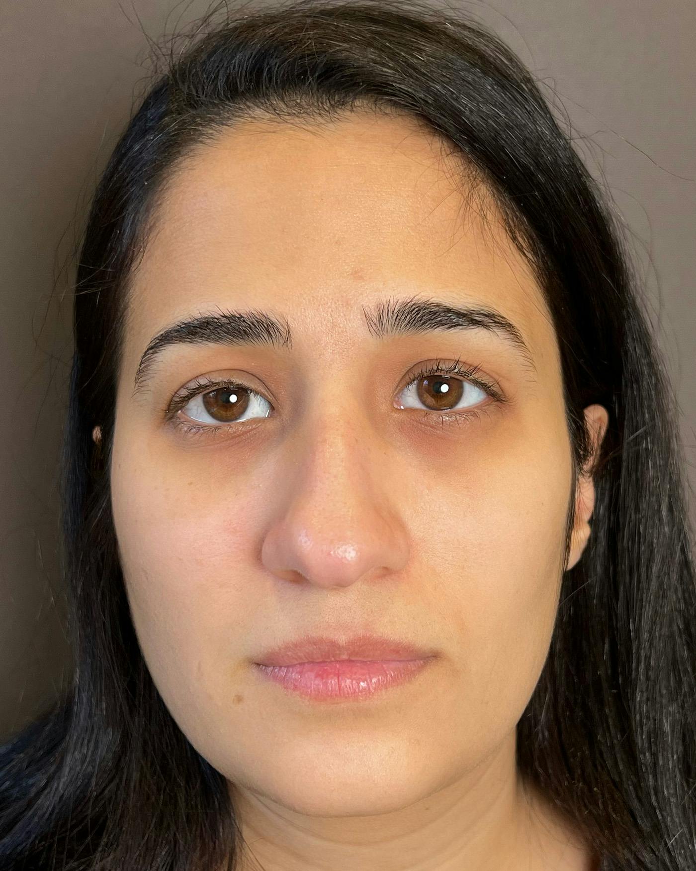 Rhinoplasty before in NYC with Albert Plastic Surgery front view