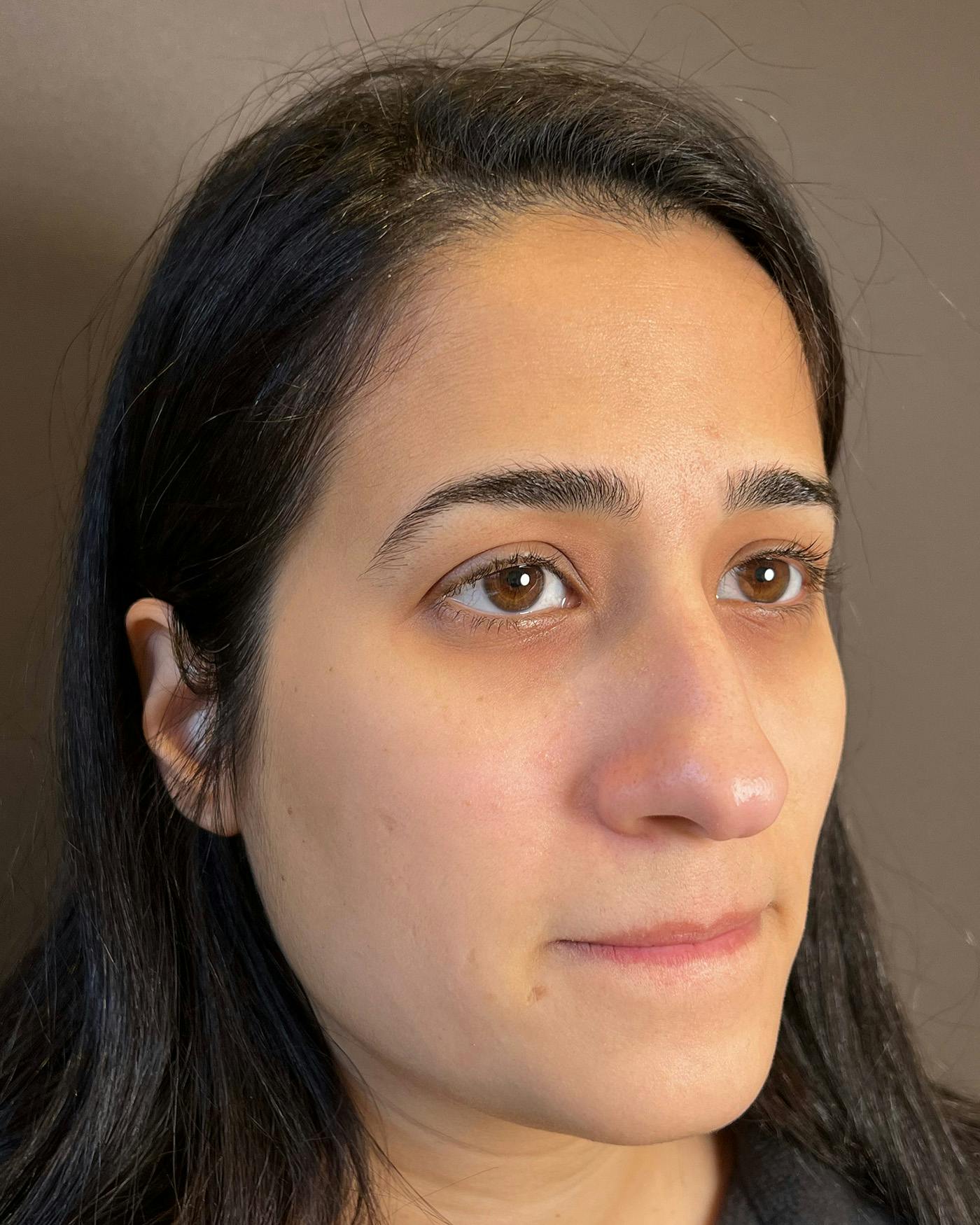 Rhinoplasty before in NYC with Albert Plastic Surgery right profile view