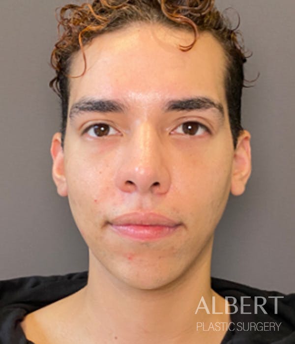 Facial Implants Before & After Gallery - Patient 131659 - Image 3