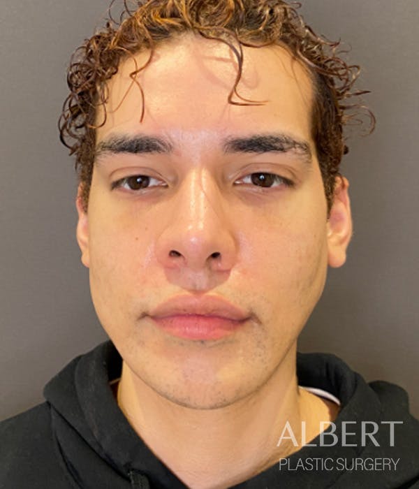 Facial Implants Before & After Gallery - Patient 131659 - Image 4