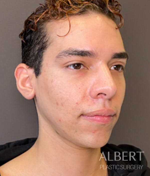 Facial Implants Before & After Gallery - Patient 131659 - Image 5