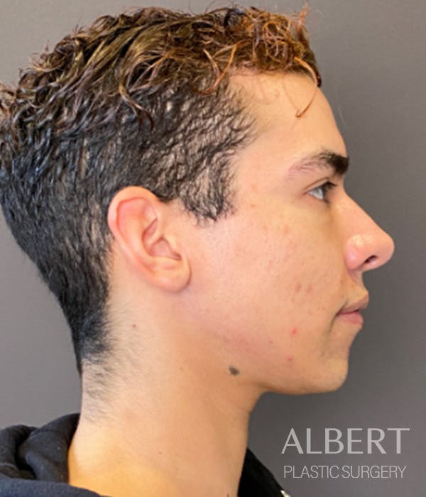 Facial Implants Before & After Gallery - Patient 131659 - Image 7