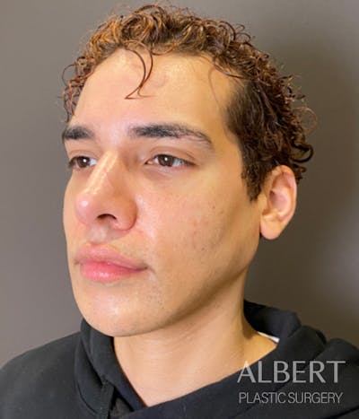 Facial Implants Before & After Gallery - Patient 131659 - Image 2