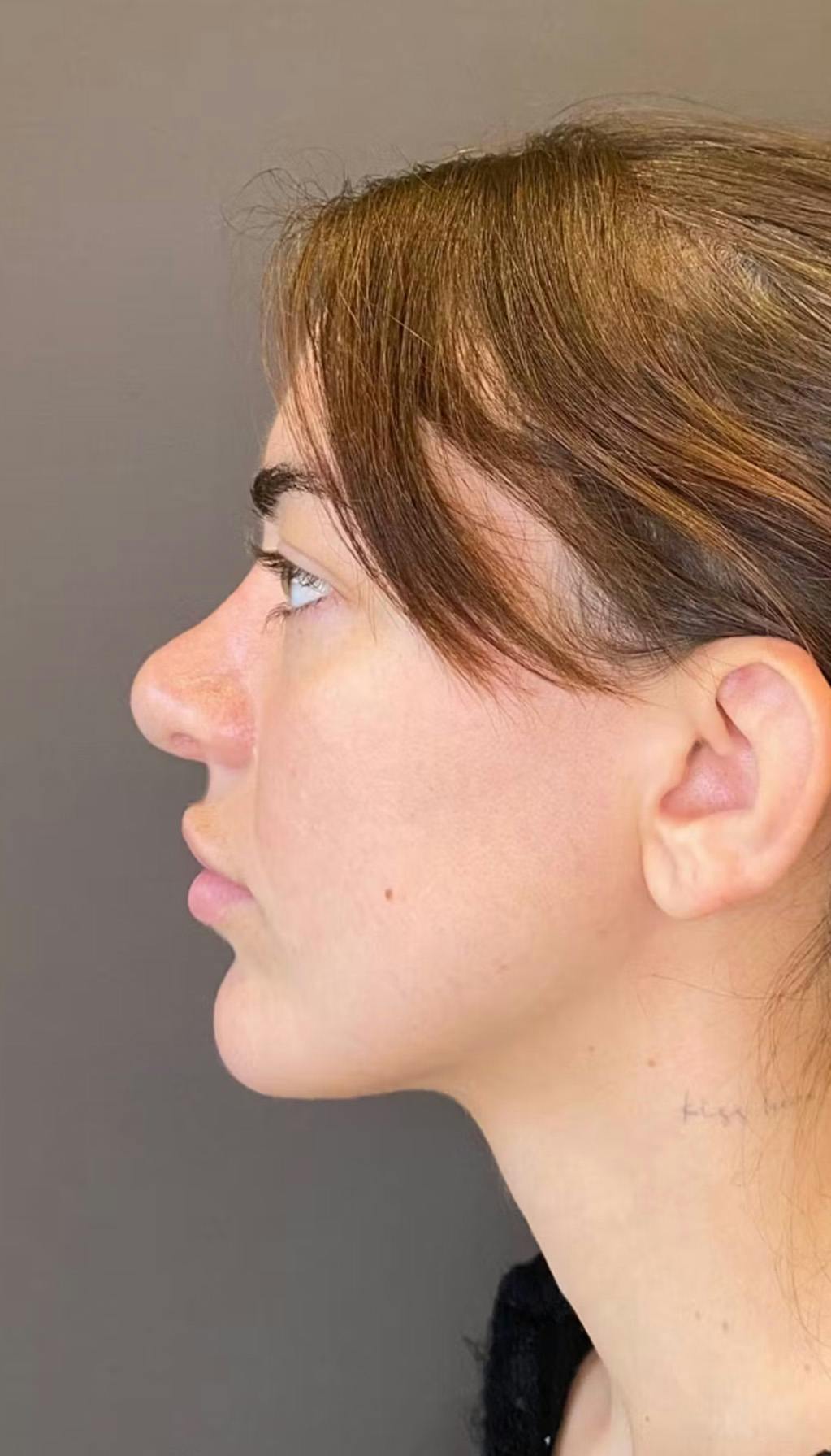 Revision Rhinoplasty Before & After Gallery - Patient 317183 - Image 5