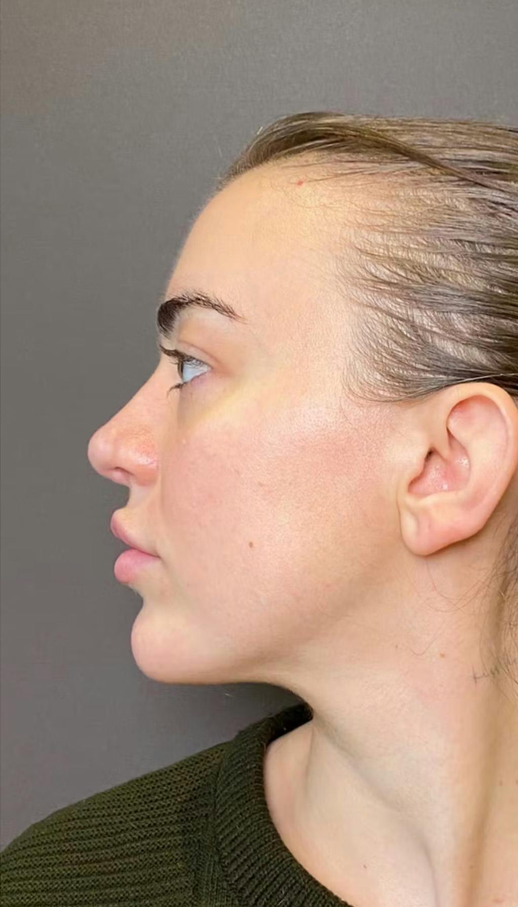 Revision Rhinoplasty Before & After Gallery - Patient 317183 - Image 6