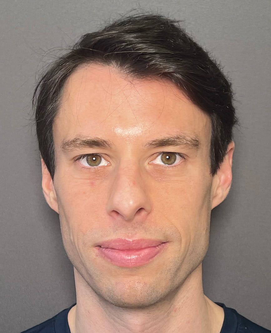 Rhinoplasty Before & After Gallery - Patient 518713 - Image 5