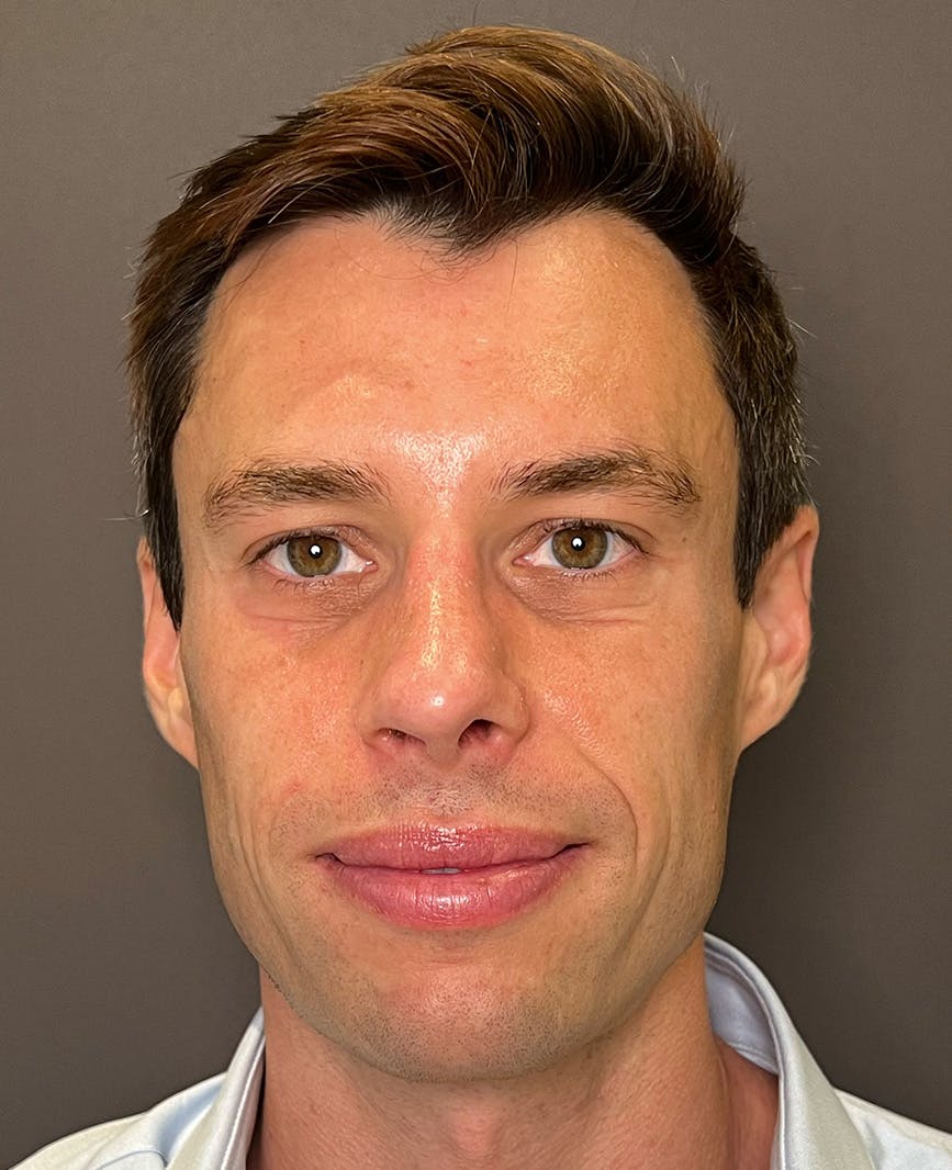 Rhinoplasty Before & After Gallery - Patient 518713 - Image 6