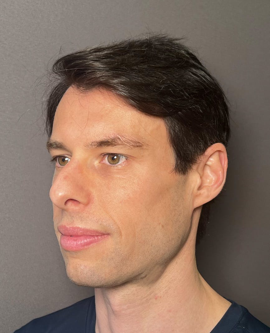 Rhinoplasty Before & After Gallery - Patient 518713 - Image 7